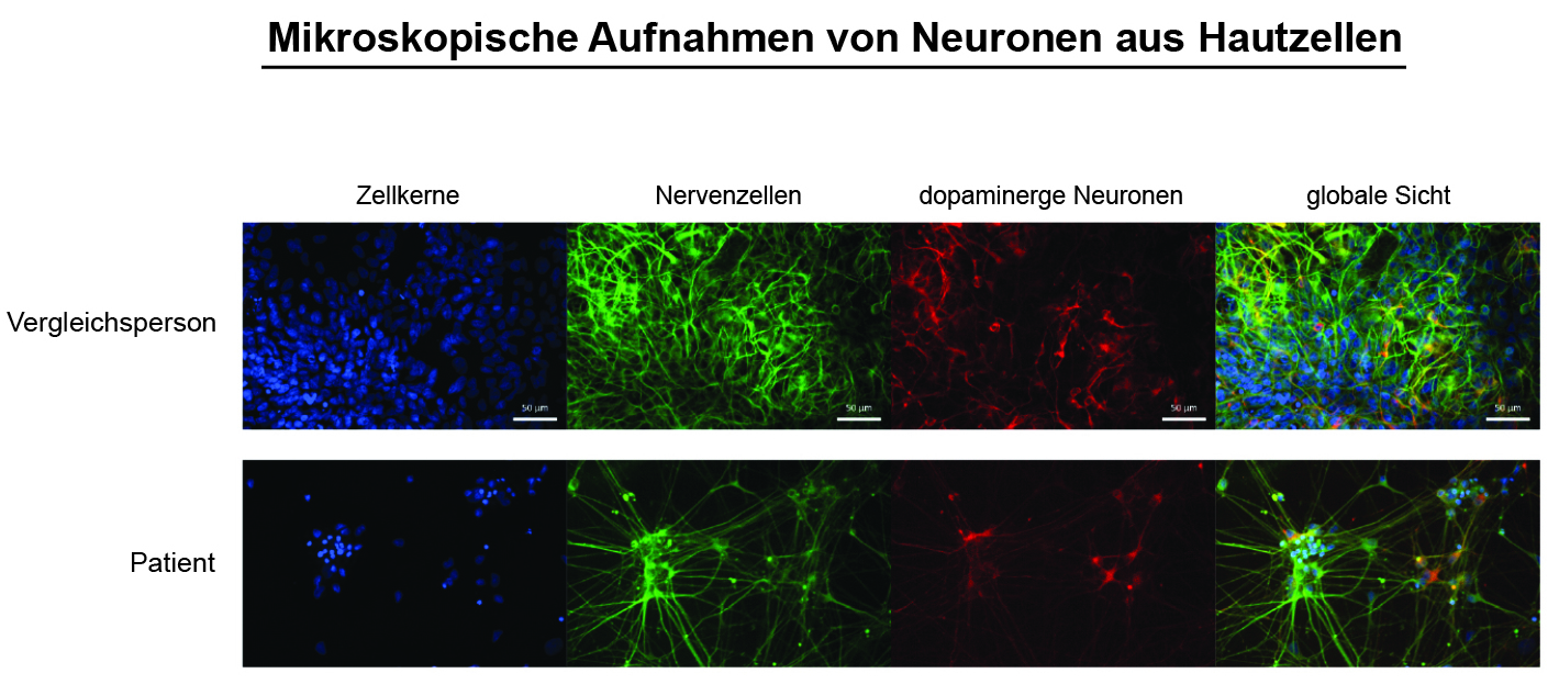 Mikroskopische Aufnahmen von Neuronen aus Hautzellen