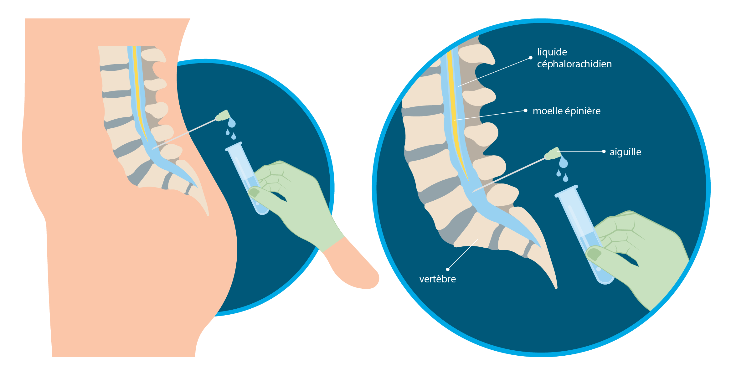 La ponction lombaire