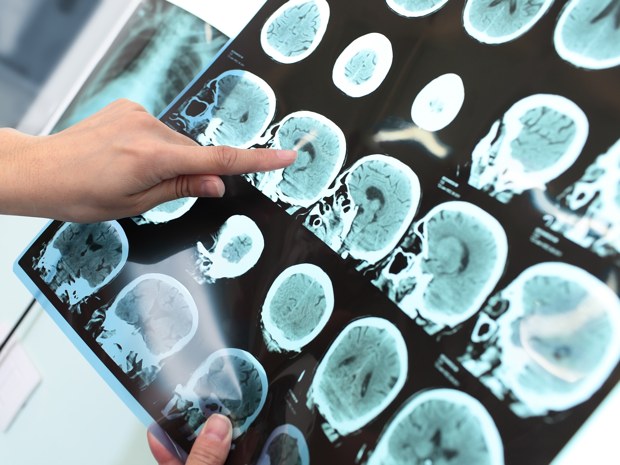 Luxemburgs Exzellenz in der Parkinson-Forschung wird weltweit bekannt    