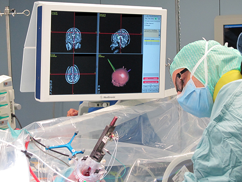 Deep Brain Stimulation